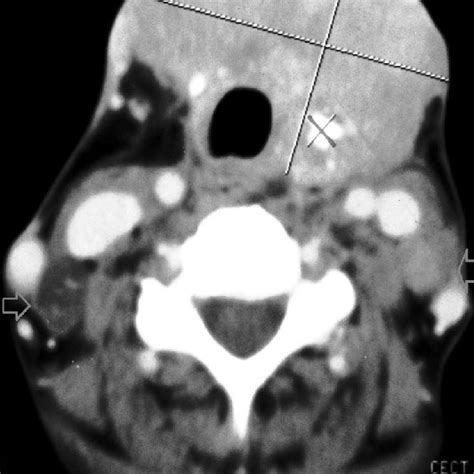 Neck Ct Scan Showing Calcifications And Enlarged Lymph Nodes Arrow