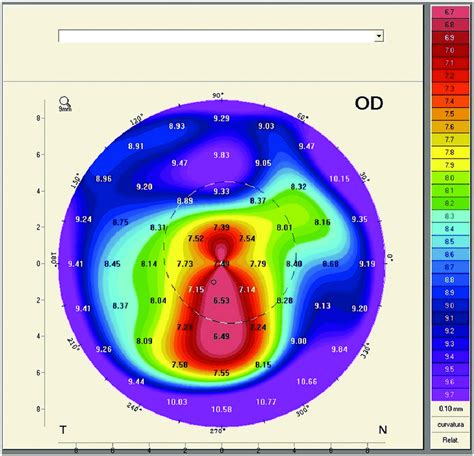 Corneal Topography In A Keratoconus Eye Download Scientific Diagram