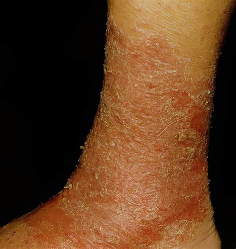 Stasis Dermatitis Pictures Symptoms Causes Treatment Diagnosis Hubpages