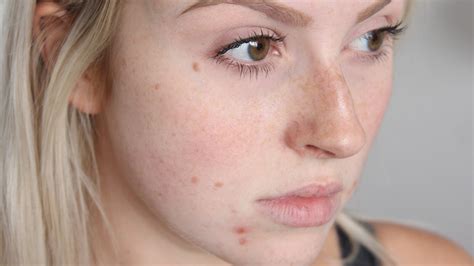 Home Remedies To Remove Red Pimples From Face चहर स लल फसय