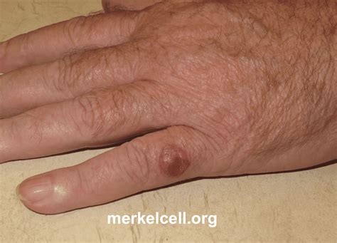 Clinical Photos Of Merkel Cell Carcinoma