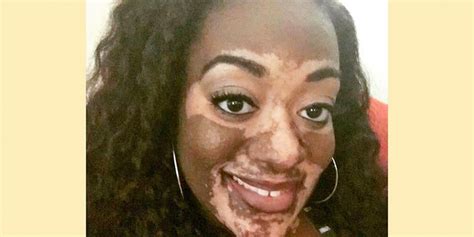 This Woman Developed Vitiligo Right Before Her Wedding Day Self