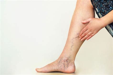 7 Important Steps To Take If A Varicose Vein Bursts Vein Envy