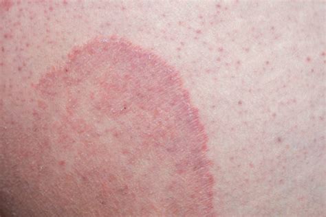 Tinea Cruris Stock Photos Pictures And Royalty Free Images Istock