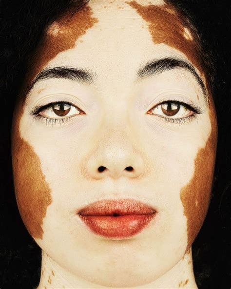 Vitiligo Une Série De Portraits Redéfinissant Lesthétisme Graine