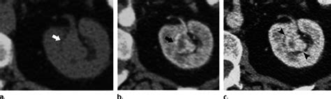 Renal Hemangioma In A 25 Year Old Woman A Nonenhanced Ct Image Shows