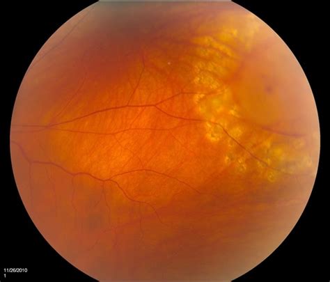 It is a surgical emergency. Lasered Retinal Tear - Retina Image Bank