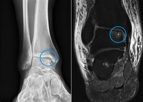 Osteochondral Lesions Of The Talus