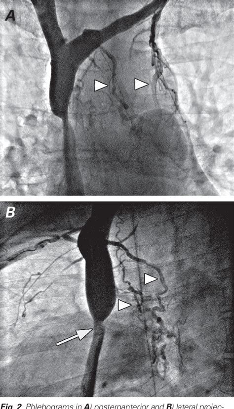 Figure 2 From Superior Vena Cava Thrombosis And Paradoxical Embolic