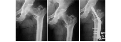 Varus Nonunion Of Trochanteric Fracture In A 38 Year Old Male