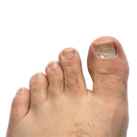 White Chalky Toenails From Nail Polish The Complete Treatment Guide