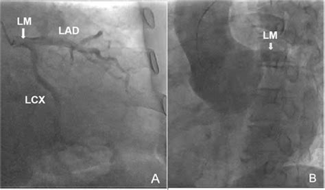 Coronary Angiography Showing The Lm Lad And Lcx A The Ostia Of The