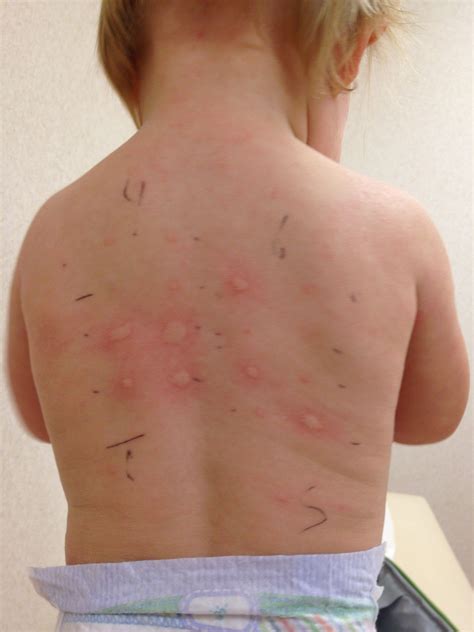Read About The Various Types Of Allergy Testing Available Follow Our