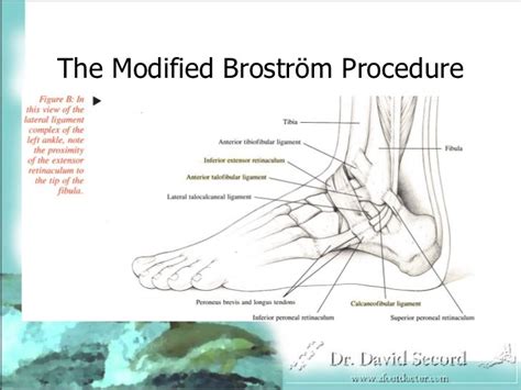 Broström Procedure Presentation