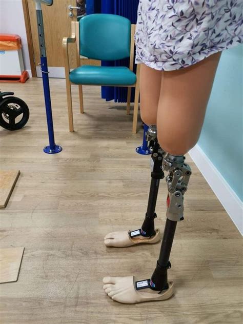 Double Amputee Prosthetic Legs