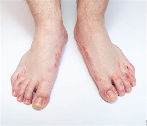 Top 104 Pictures Contact Dermatitis On Feet Pictures Completed