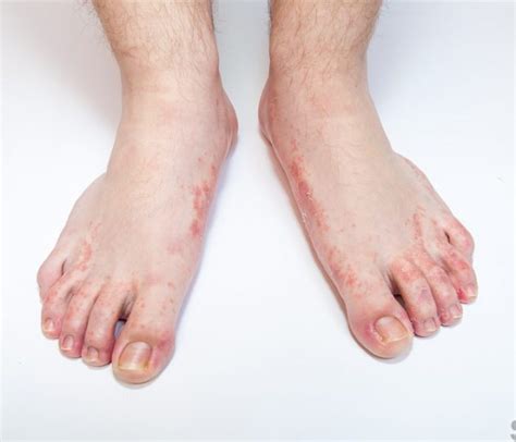 Foot Rash Causes Symptoms Home Remedies And Treatment Pictures