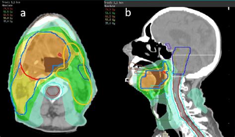 Intensity Modulated Radiotherapy Planning Of Head And Neck Cancer