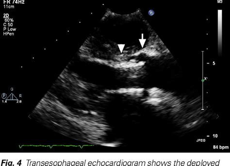 Figure 1 From Transcatheter Aortic Valve Implantation In A Patient With