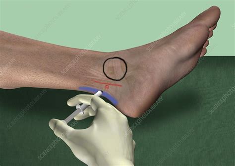 Posterior Tibial Nerve Block Artwork Stock Image C0166832