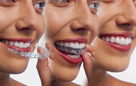 How To Make Invisalign More Comfortable Bracesetters