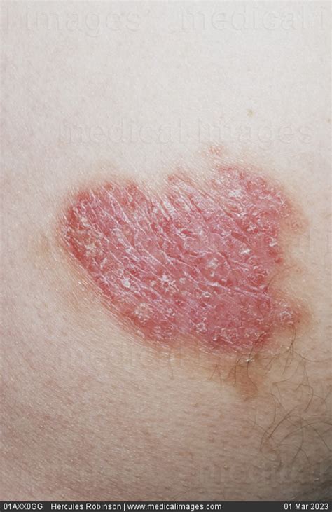 Stock Image Dermatology Psoriasis A Scaly Dark Red Patch On The Torso