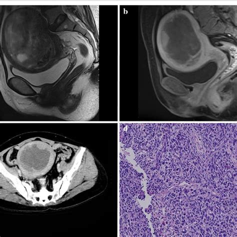 A 53 Year Old Woman With Uterine Carcinosarcoma Ucs Sagittal T2wi