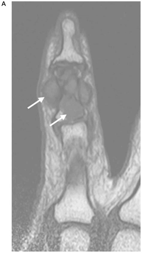 Coexistence Of Giant Cell Tumor Of Tendon Sheath And Enchondroma In The