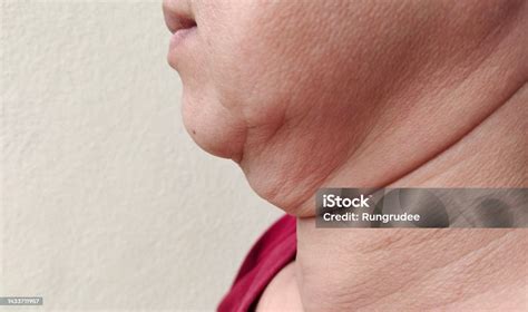 The Flabbiness Adipose Sagging Skin Under The Neck Of The Woman Stock