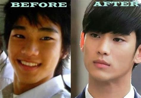 Kim Soo Hyun Plastic Surgery Before After
