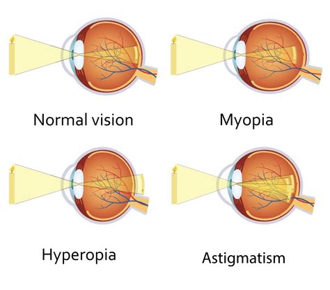 Myopia Control Burnett Hodd And Tam Optometry