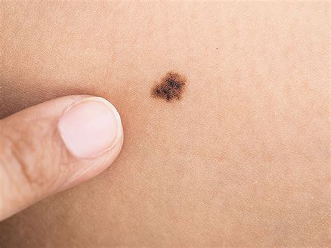 Simple Melanoma Risk Test Count The Moles On An Arm