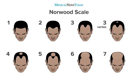 The Norwood Scale Understanding The Stages Of Balding