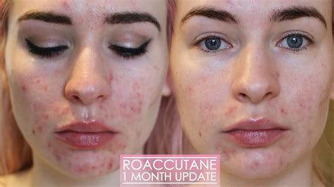 1 Month Roaccutane Update Side Effects And My Skin Now Youtube