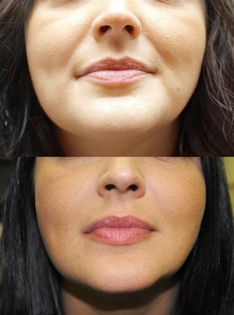 Fillers For Nasolabial Folds Before And After Before And After