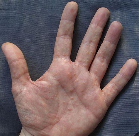 Palm Skin Rash Types Causes Pictures Treatment Healthhype Com