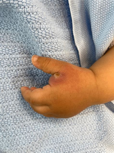 Cureus Hand Furuncular Myiasis Of An Infant In The Western Region Of Saudi Arabia A Case Report