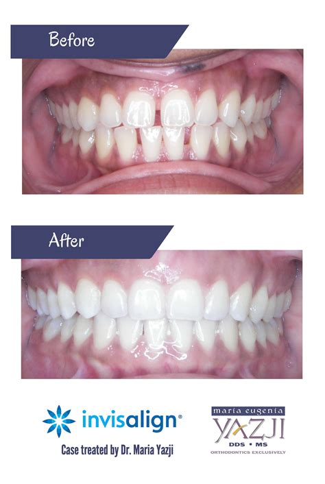 Learn more on how to fix gaps in teeth here. Pin on Invisalign Before & After