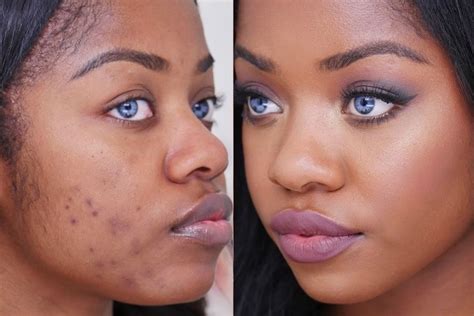 How To Easily Get Rid Of Acne And Pimples With Apple Cider Vinegar