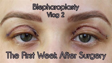 Lower Blepharoplasty Near Me Rewarded Cyberzine Navigateur