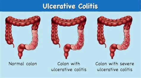 Ulcerative Colitis Causes Signs And Ayurvedic Treatment