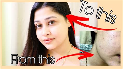 How To Remove Makeup Properly Best Makeup Remover For Acne Prone And Sensitive Skin Megha