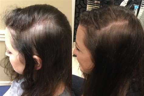 Microneedling With Prp Evansville Prp Hair Restoration Evansville In