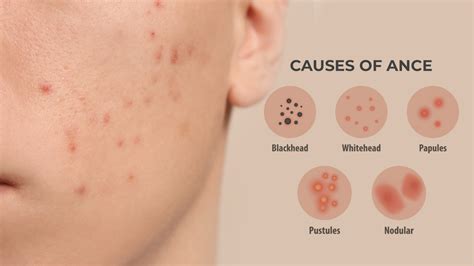 5 Types Of Acne You Should Know About Causes Of Acne Acne Fighter
