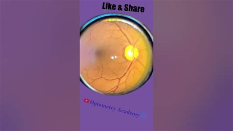 Smartphone Fundus Videography Fundus Photography Short Video 18