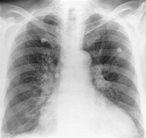 Figure 1 From Aortic Calcification On Plain Chest Radiography Increases