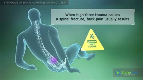 Spinal Compression Fracture Symptoms Youtube