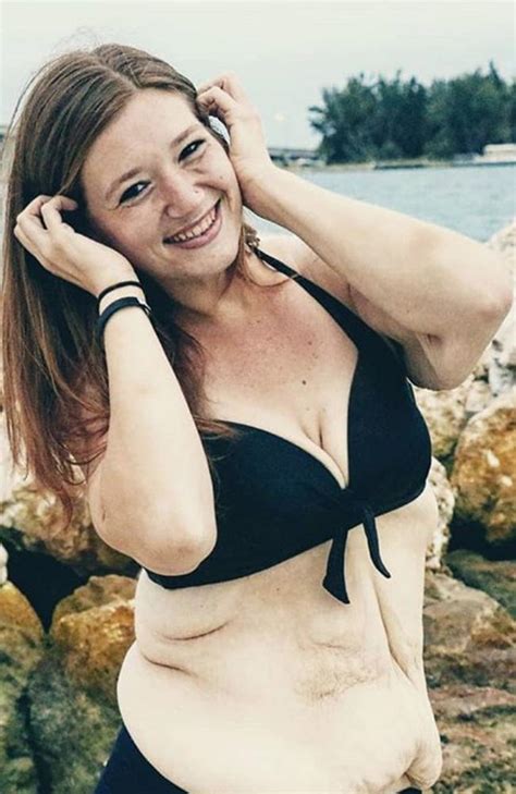 Fatgirlfedup Lexi Reed Shows Off Surgery To Remove Excess Skin After Weightloss Nt News