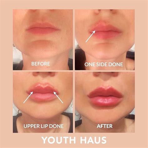 Collagen Lips Before After Pictures