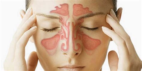 Sinusitis Qué Es Síntomas Tipos Y Tratamiento Eom Internacional
